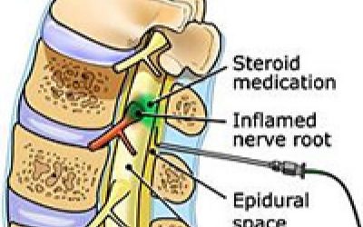 Epidural Steroid injections