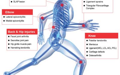 Platelet rich plasma treatment areas