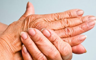 Arthritis: The Preventable Disease?